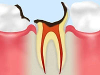 重度の虫歯を救う根管治療について